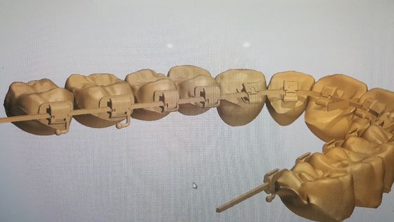 강력한 기계 원천 DTC 정형 치과 자결 브래킷을 가진 혀 브레이크